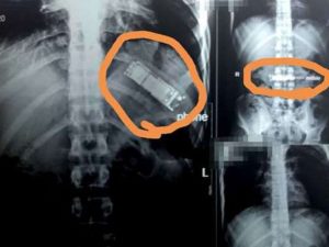 mobile in stomach